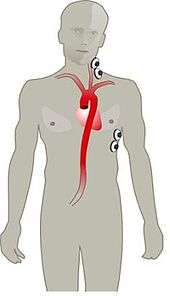 Electrode array that measures Thoracic electrical bioimpedance (TEB)