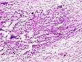 Pulmonary adeocaricnoma (1) localized noninvasive type.jpg