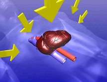 Thoracic and Cardiac Pump combined